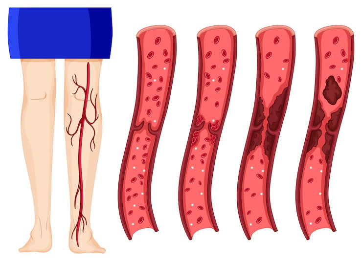 Blod clot in blood vein of leg